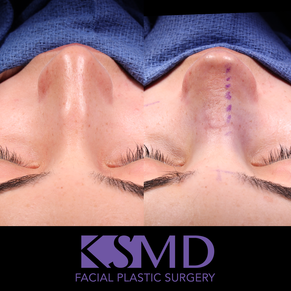 AG frontal intraop