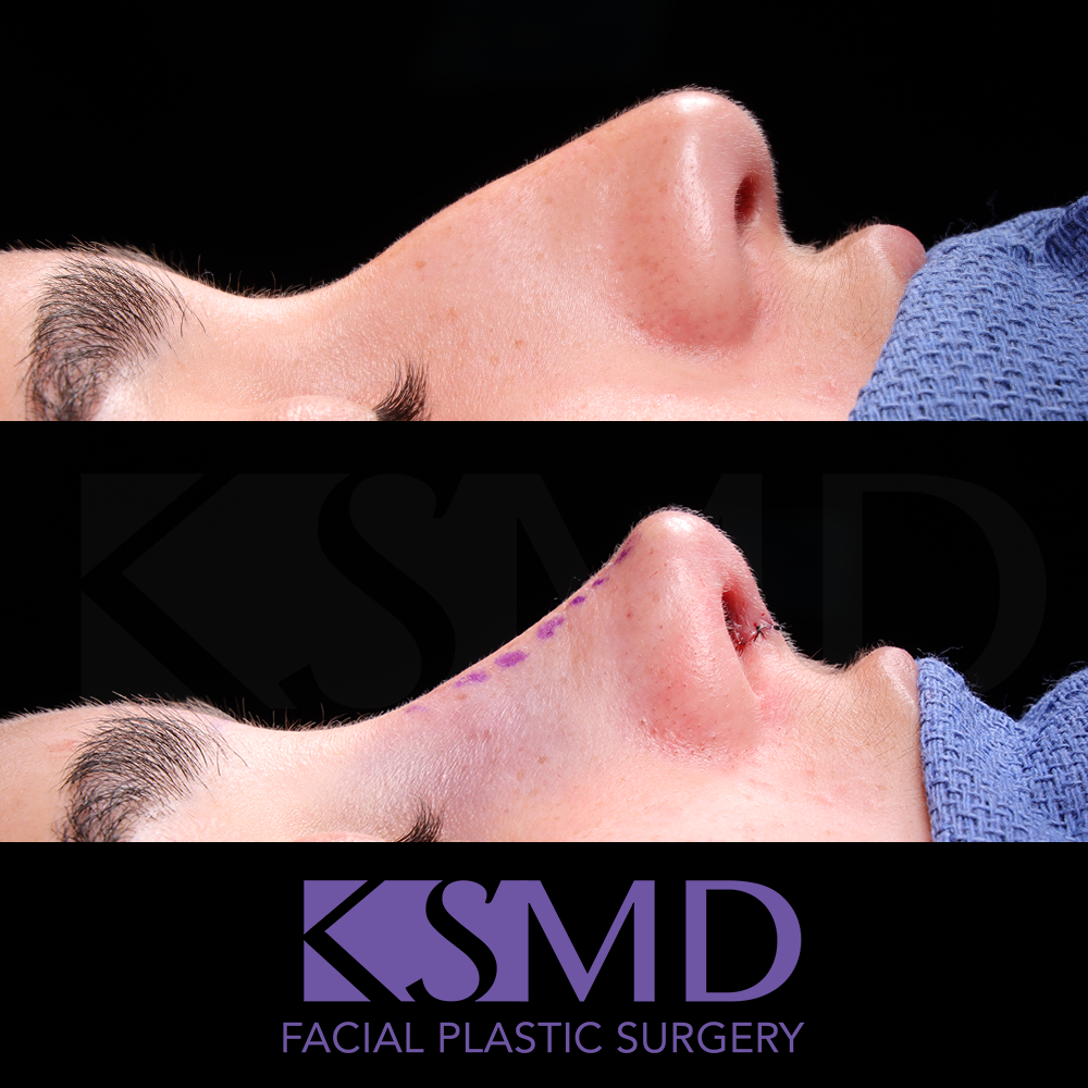 AG profile 1 intraop