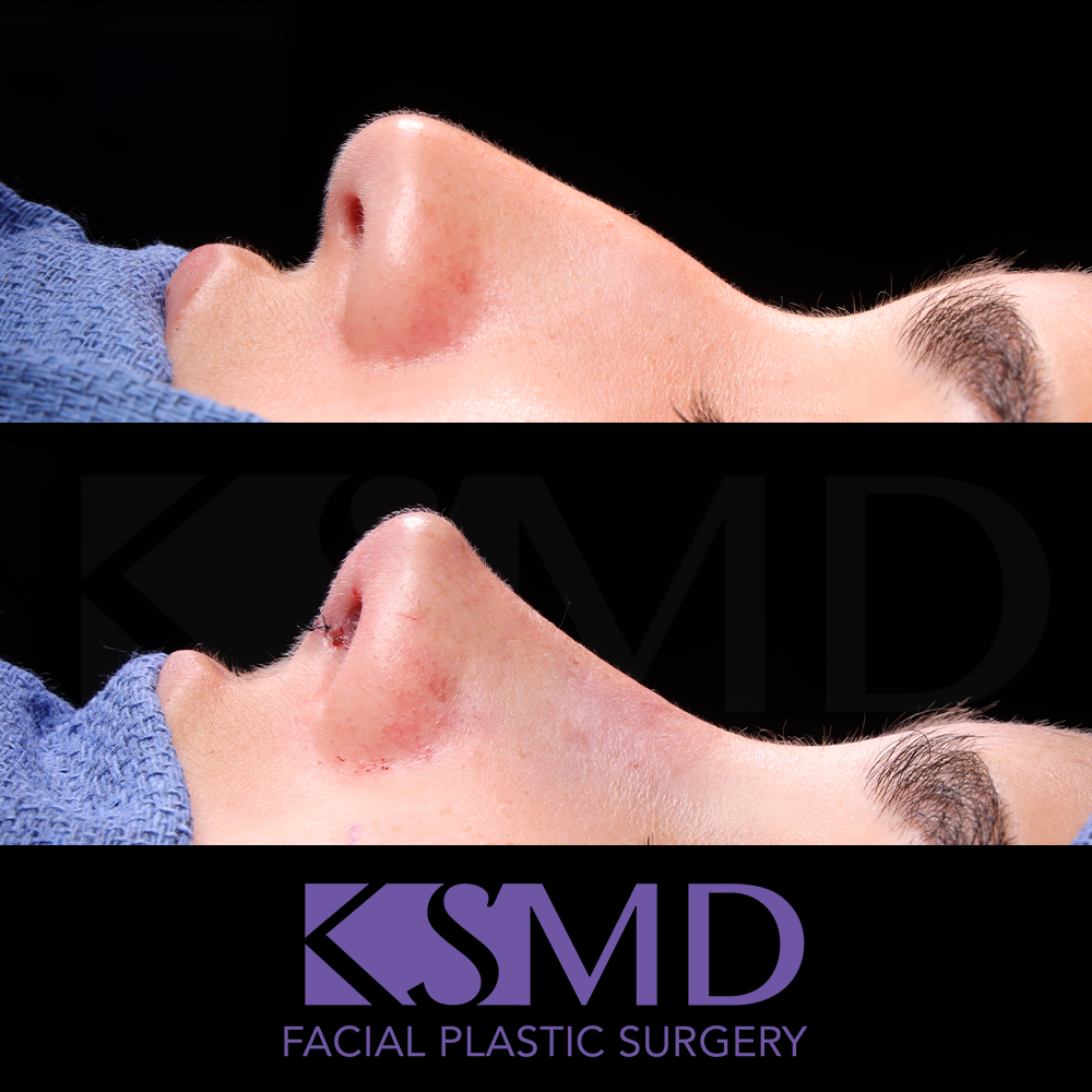 AG profile 2 intraop