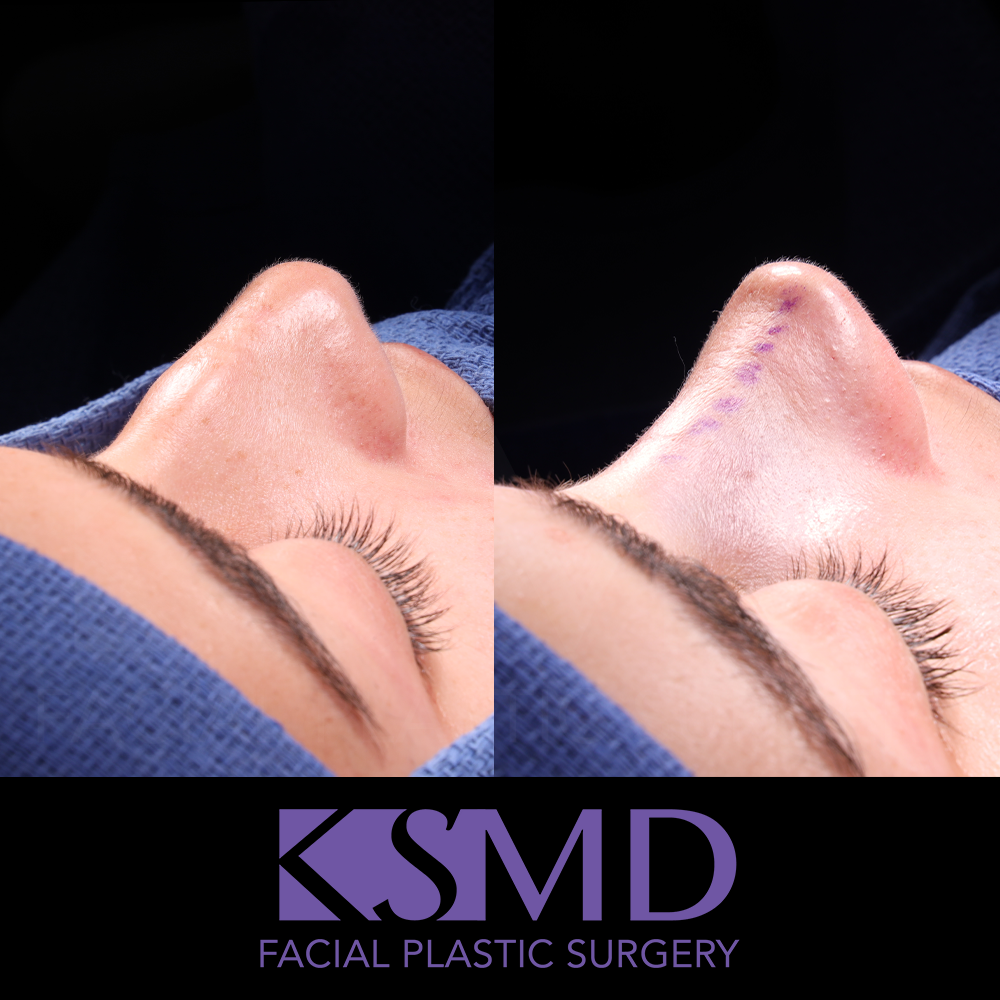 AG side oblique intraop
