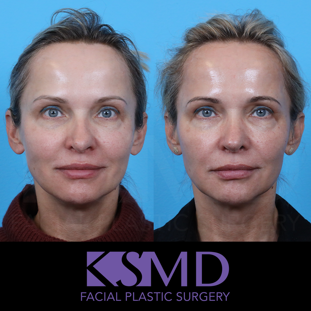 AS 6 month frontal