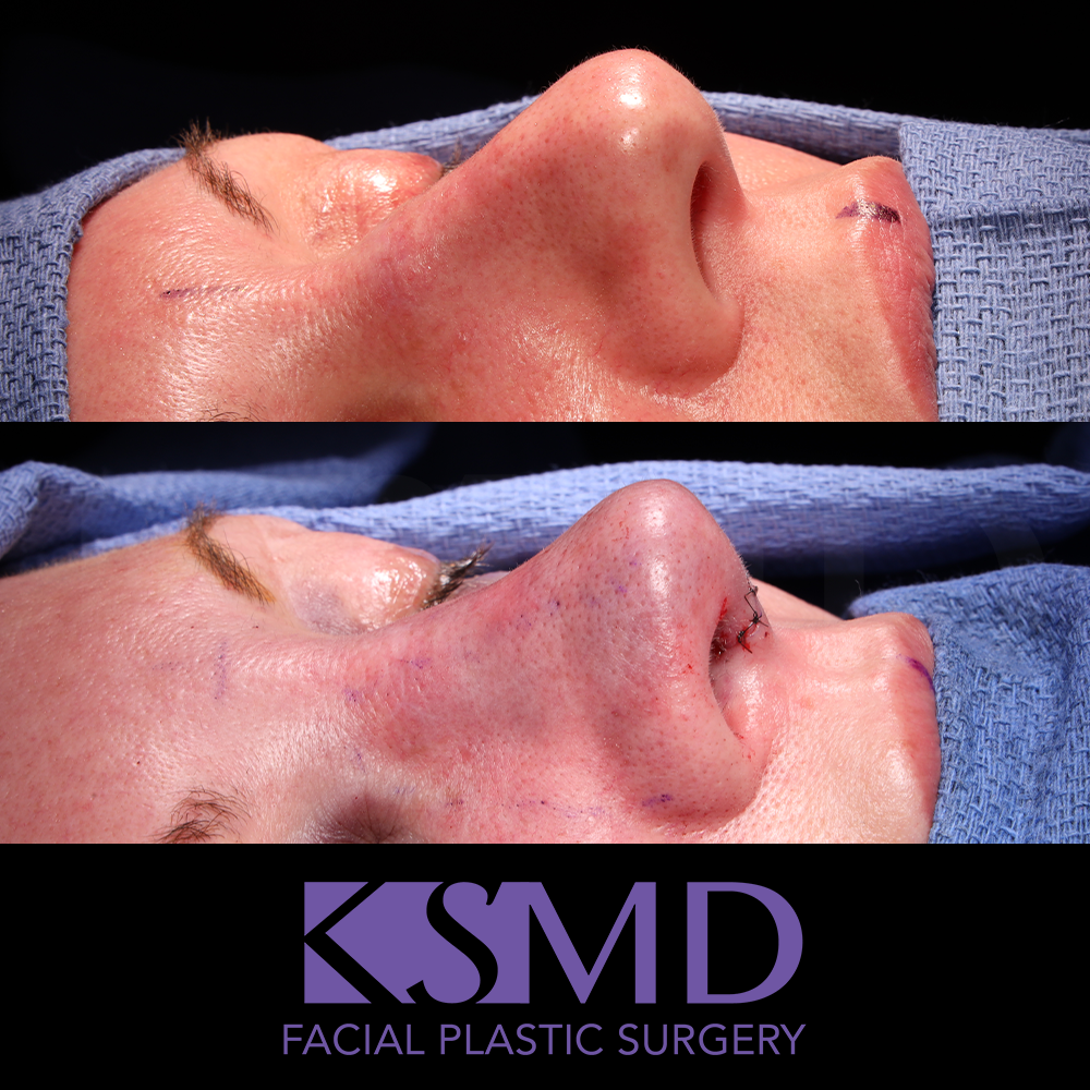 Heidi Harris Oblique 2 intraop rhinoplasty