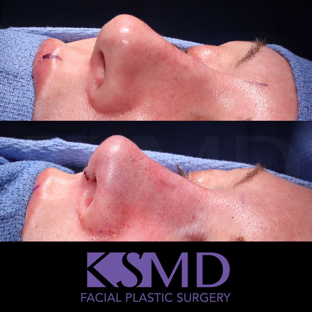 Heidi Harris Oblique 3 intraop rhinoplasty