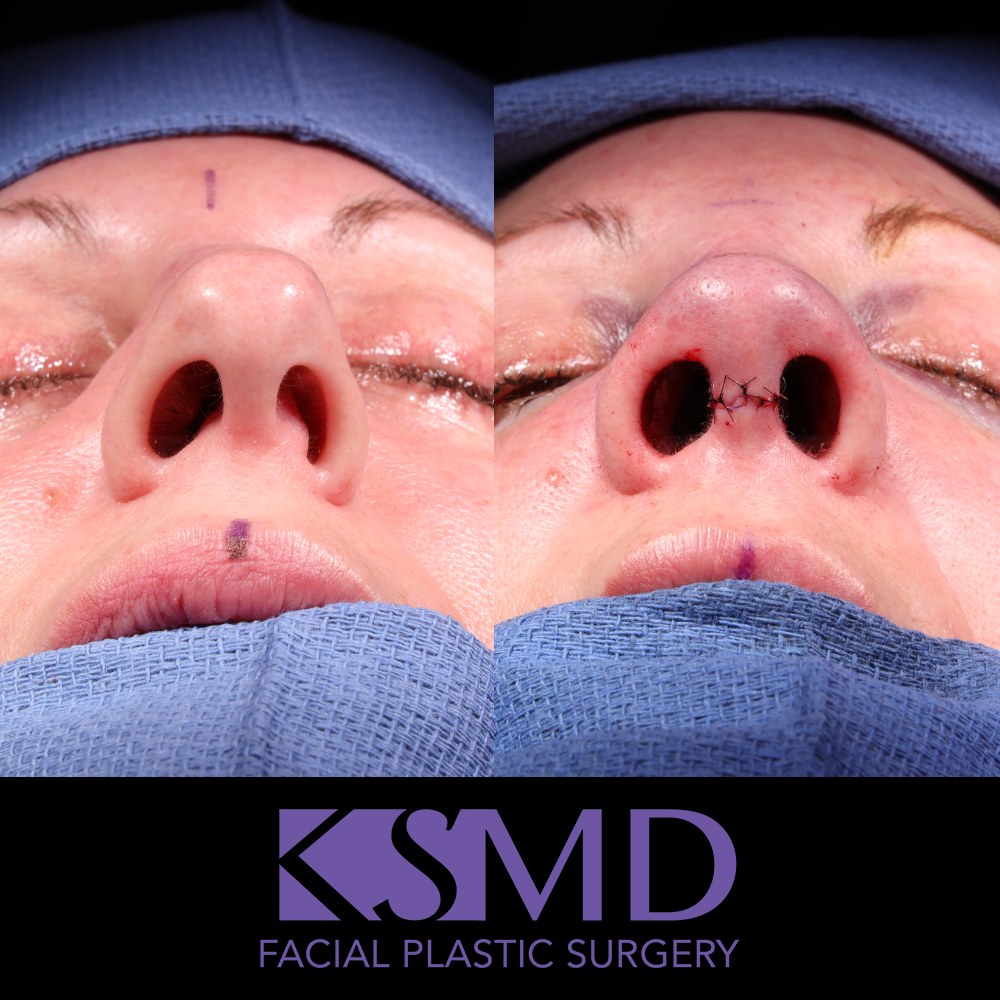 Heidi Harris basal intraop rhinoplasty