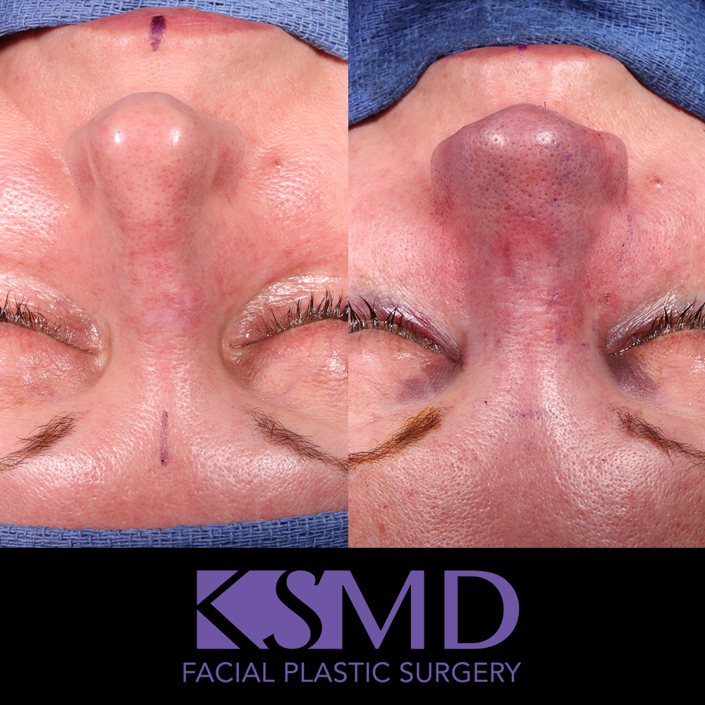 Heidi Harris frontal intraop rhinoplasty