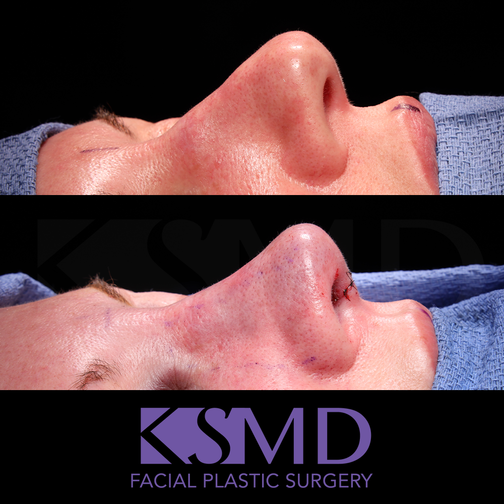 Heidi Harris oblique 1 intraop rhinoplasty