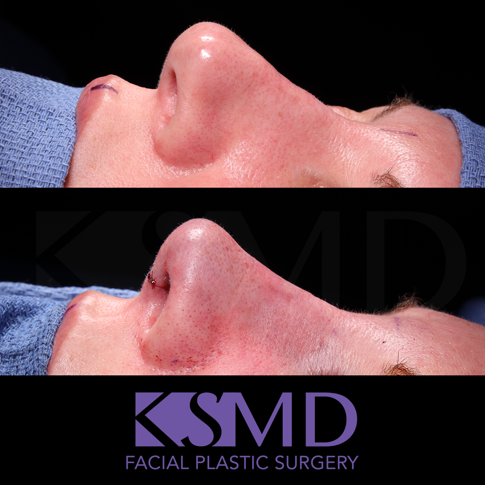 Heidi Harris oblique 4 intraop rhinoplasty