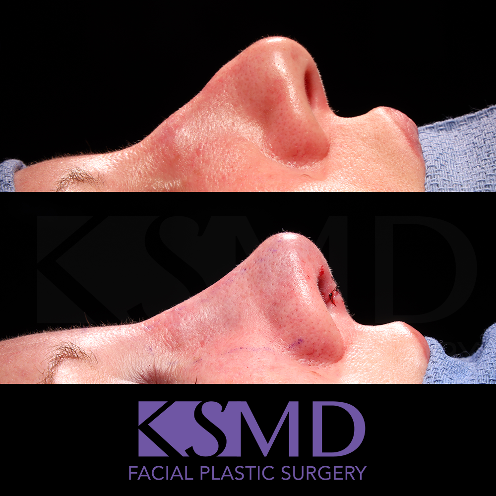 Heidi Harris profile 1 intraop rhinoplasty