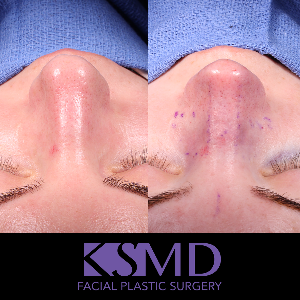 JD intraop frontal