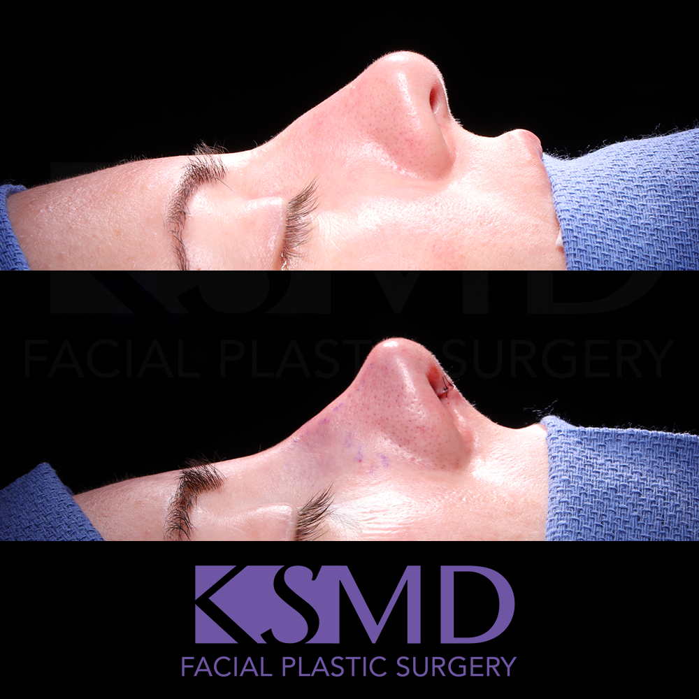 JD intraop profile 1