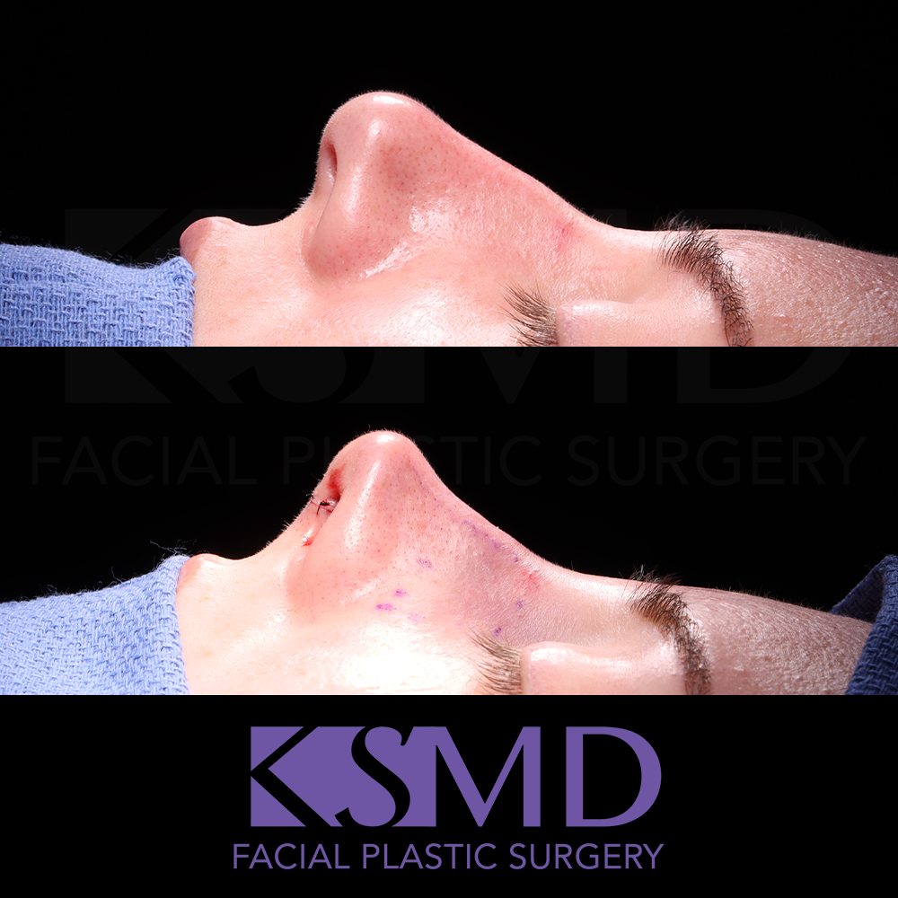 JD intraop profile 2