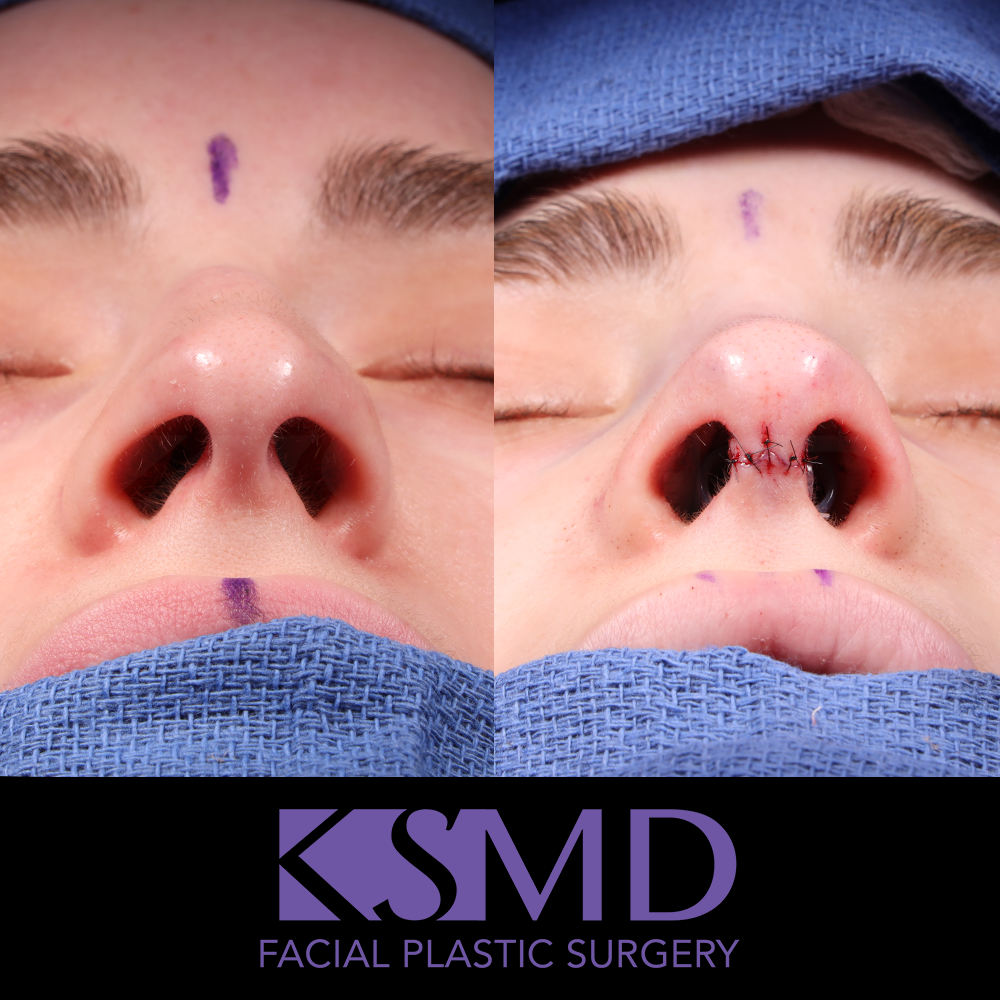 JP basal intraop