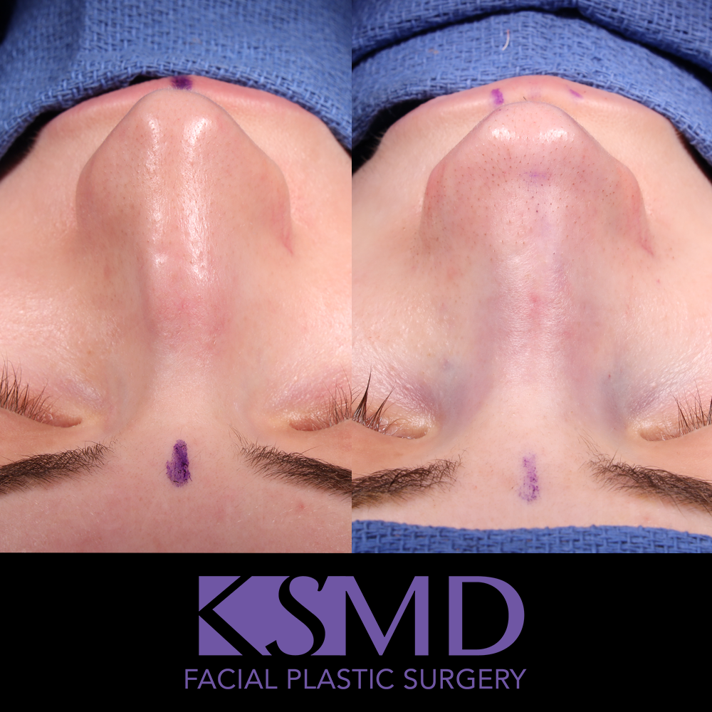 JP frontal intraop