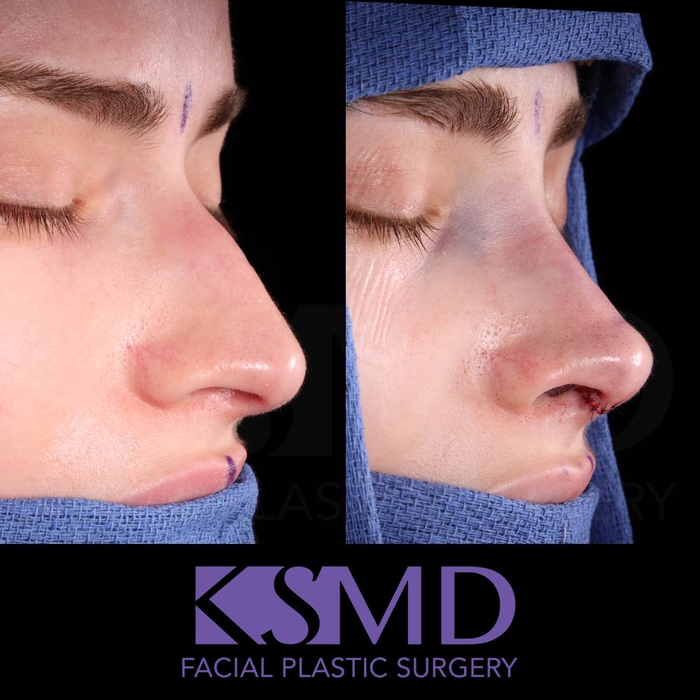 JP oblique 1 intraop
