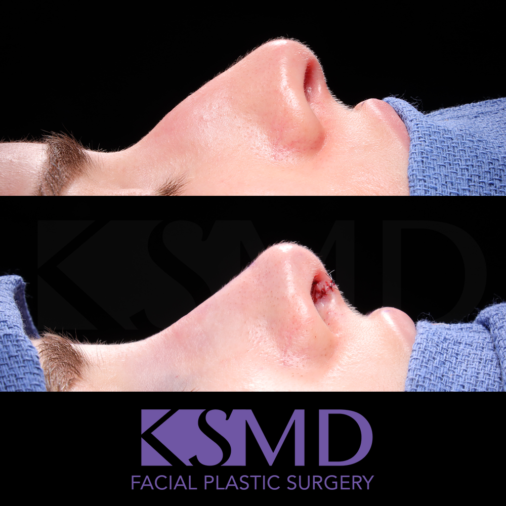 JP profile 1 intraop