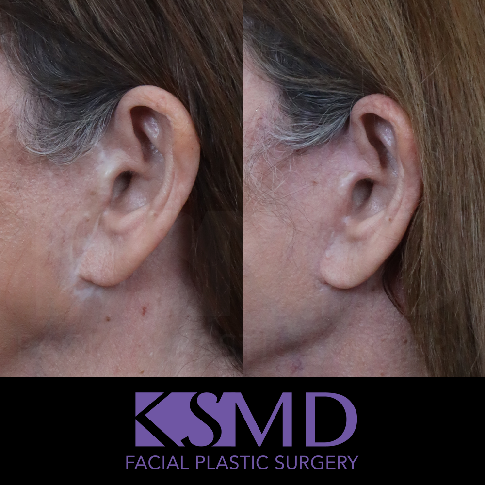 JW facelift scars