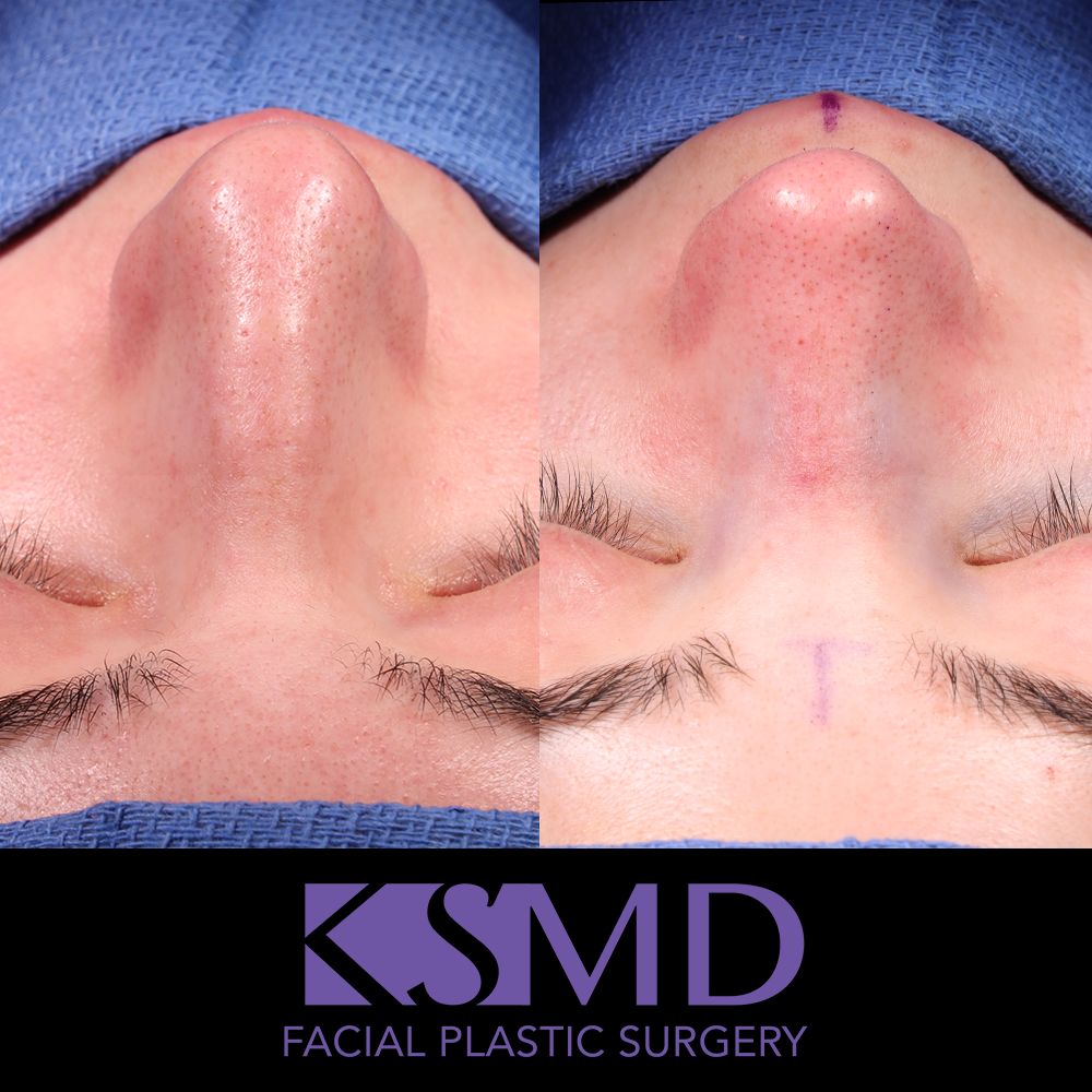 KD frontal intraop
