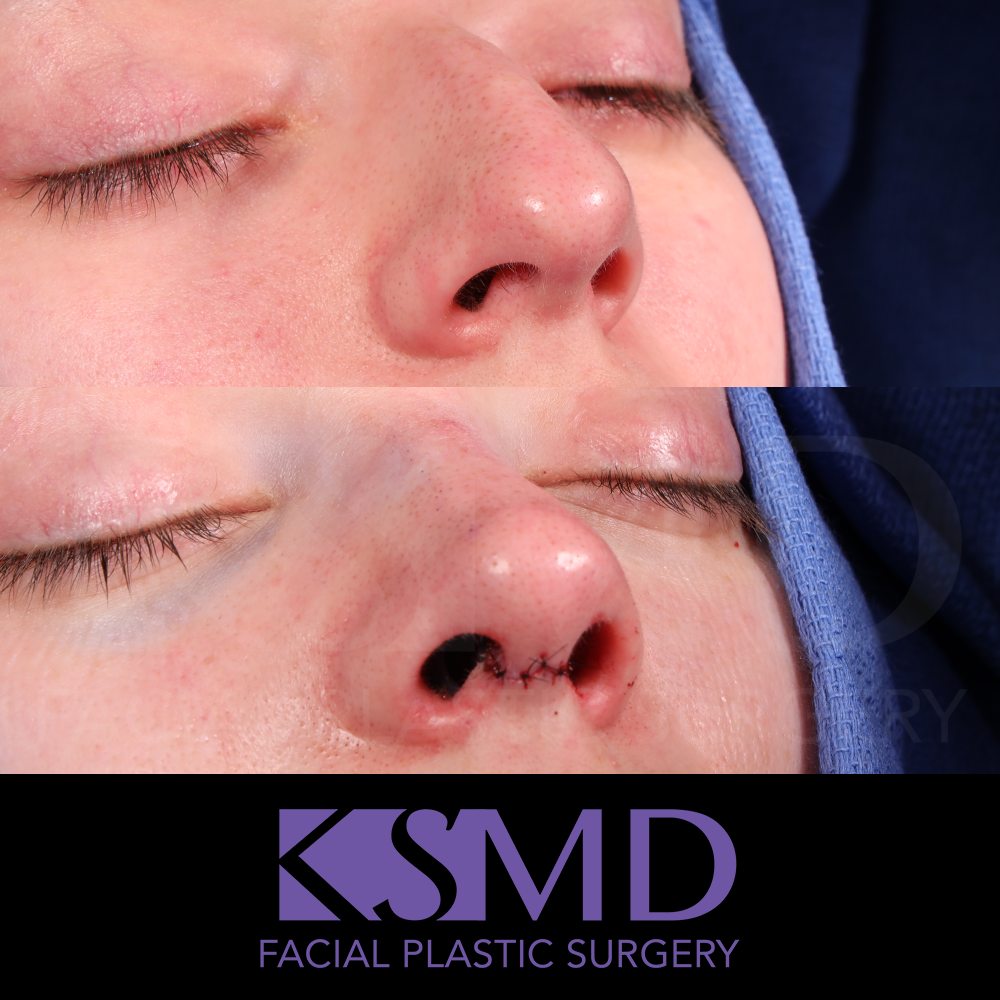 KD oblique 1 intraop