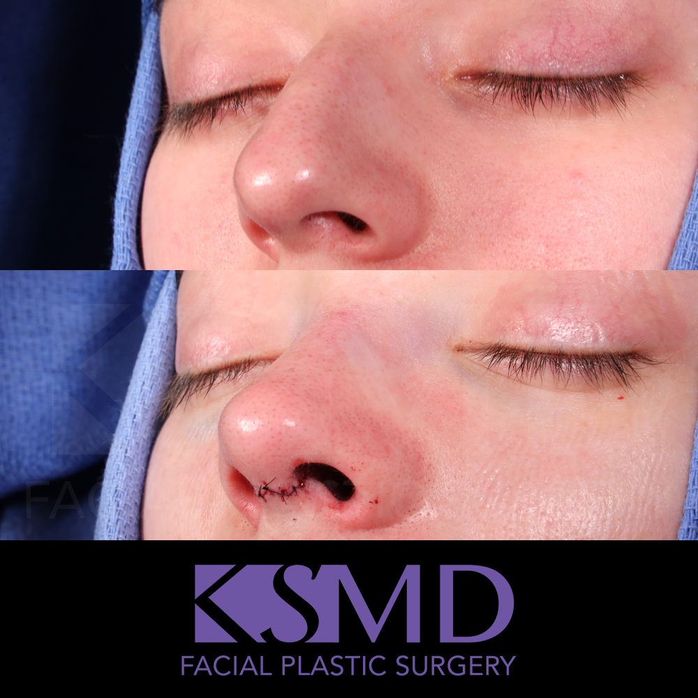 KD oblique 2 intraop