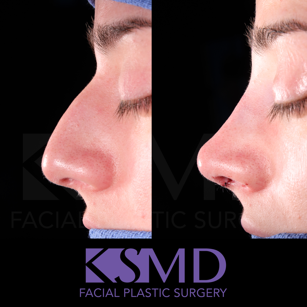 KD profile 2 intraop