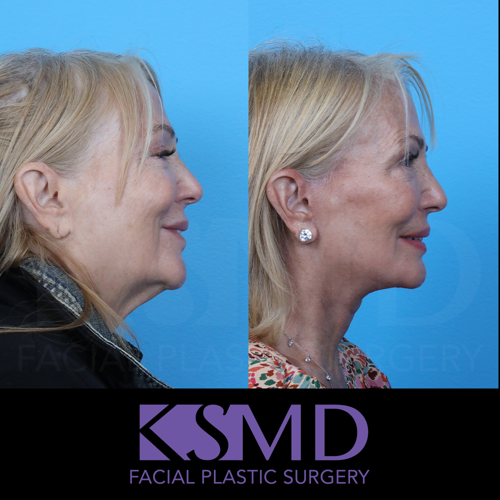 KR Profile 2 smile
