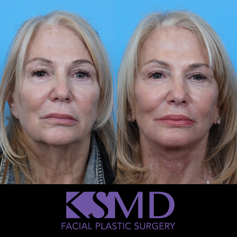 KR frontal