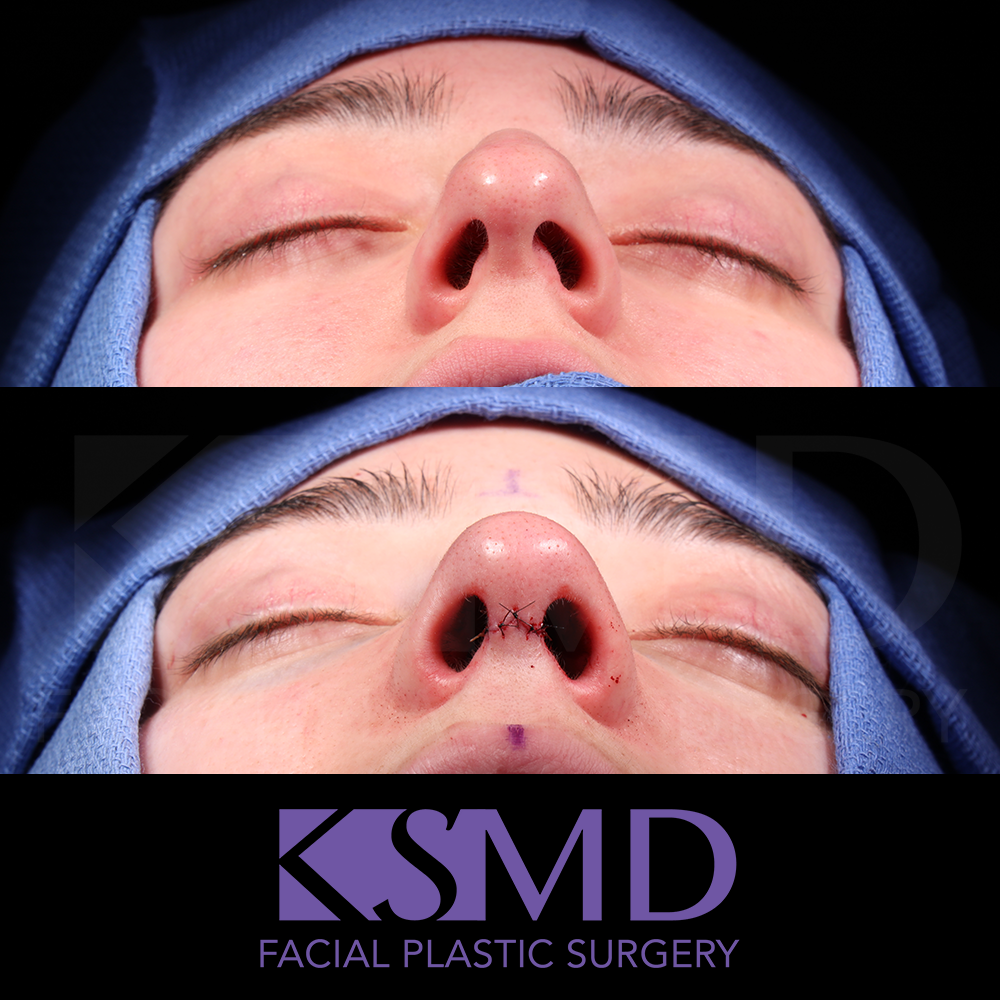 KS basal intraop