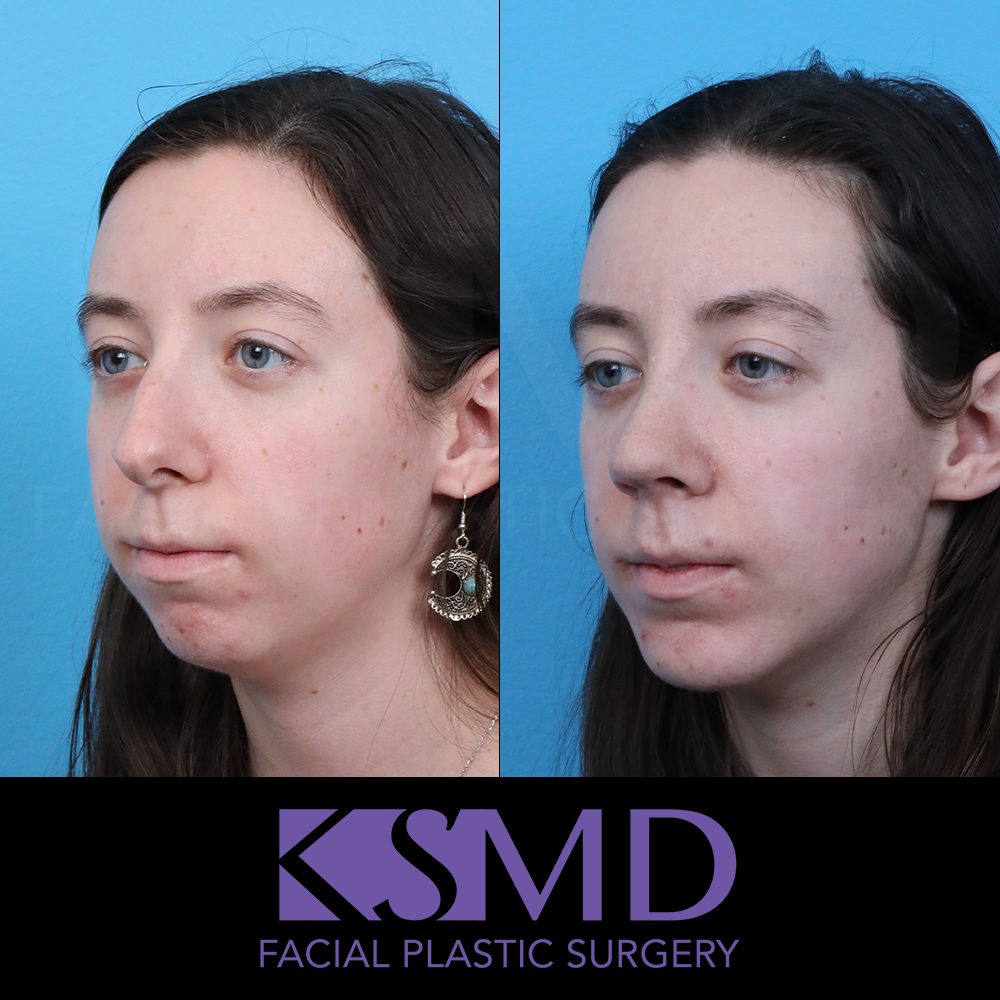 MG 3 month oblique 1