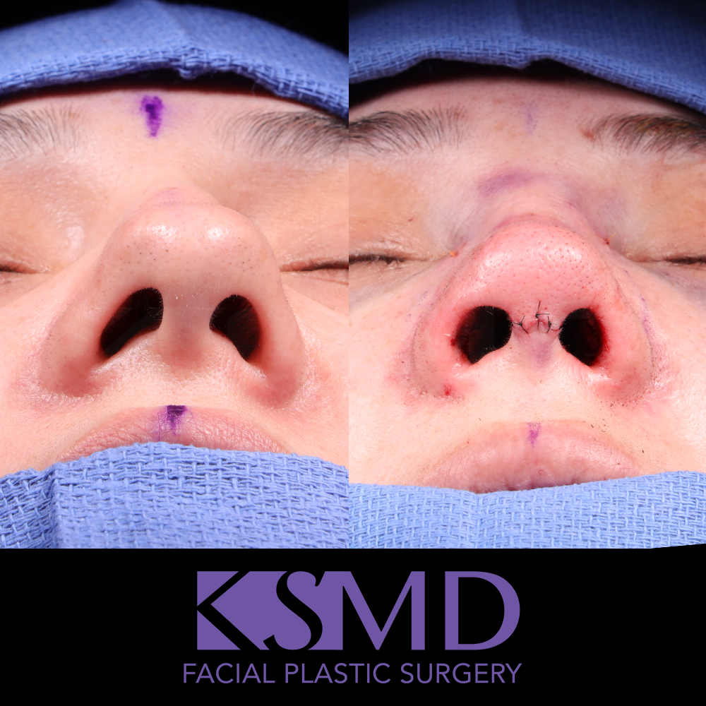 MG basal intraop