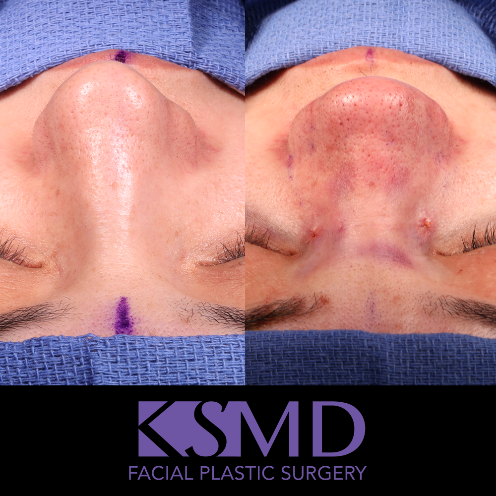 MG frontal intraop