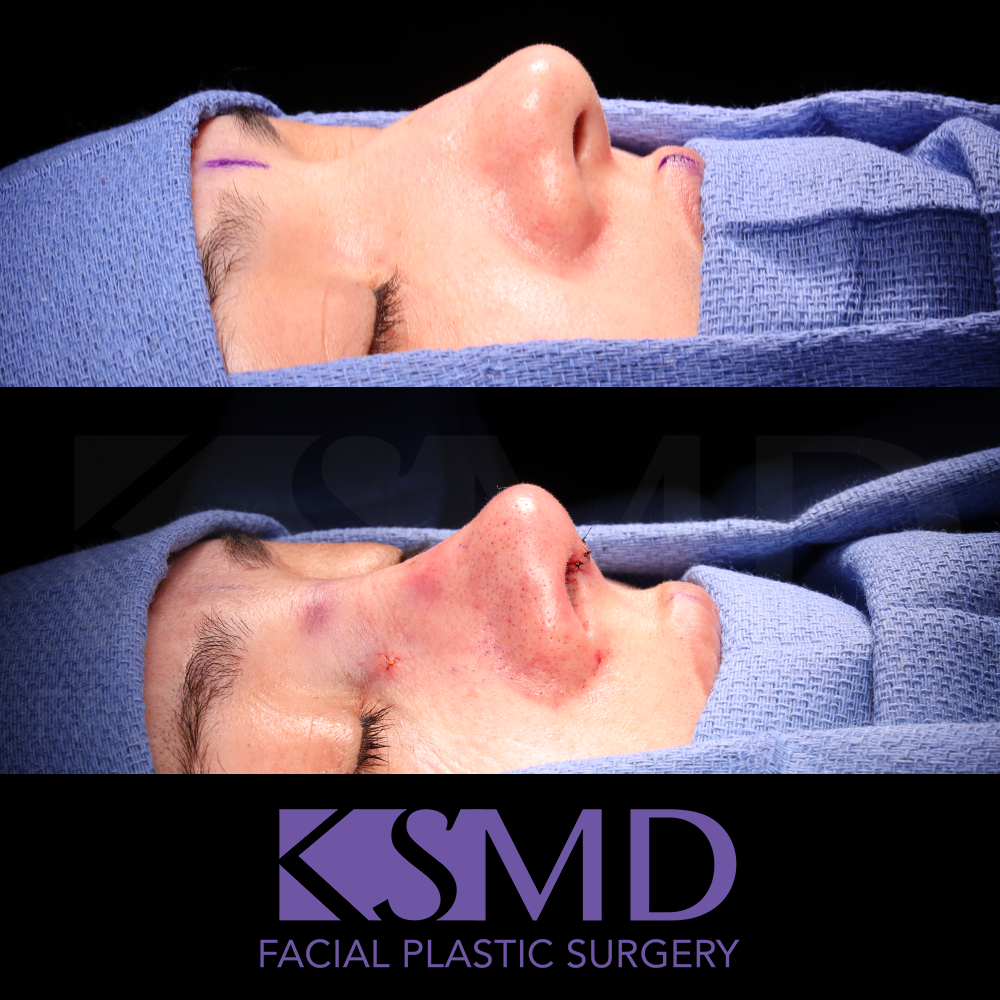 MG oblique 1 intraop