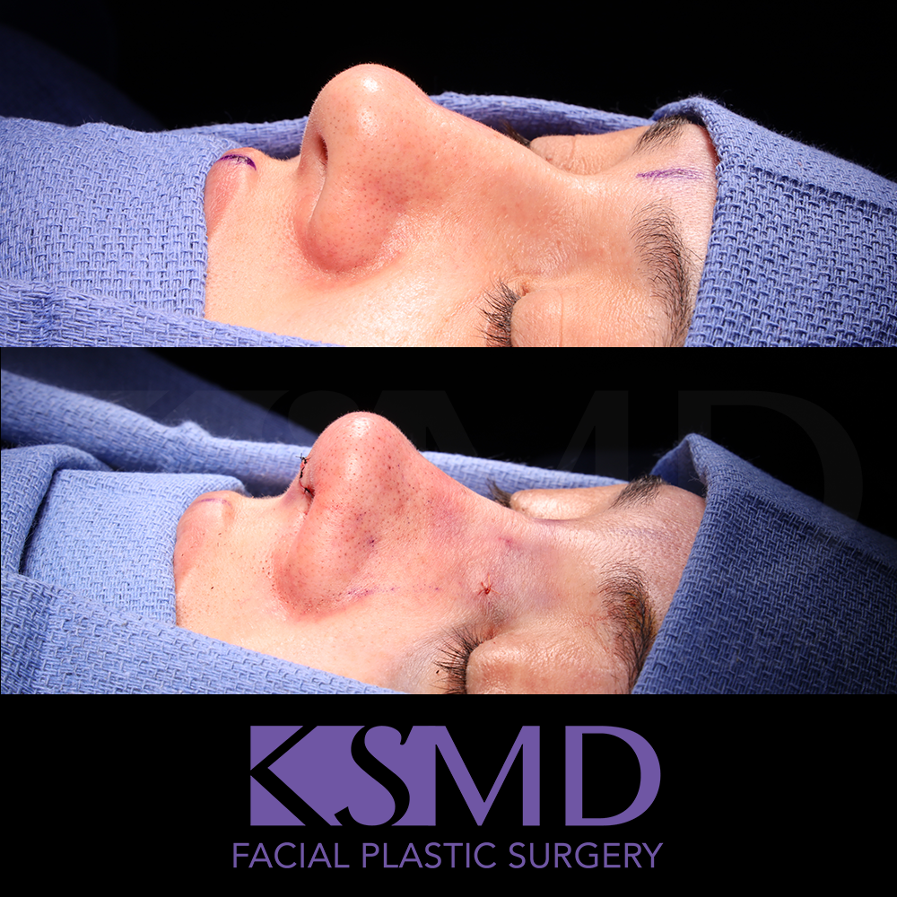 MG oblique 2 intraop