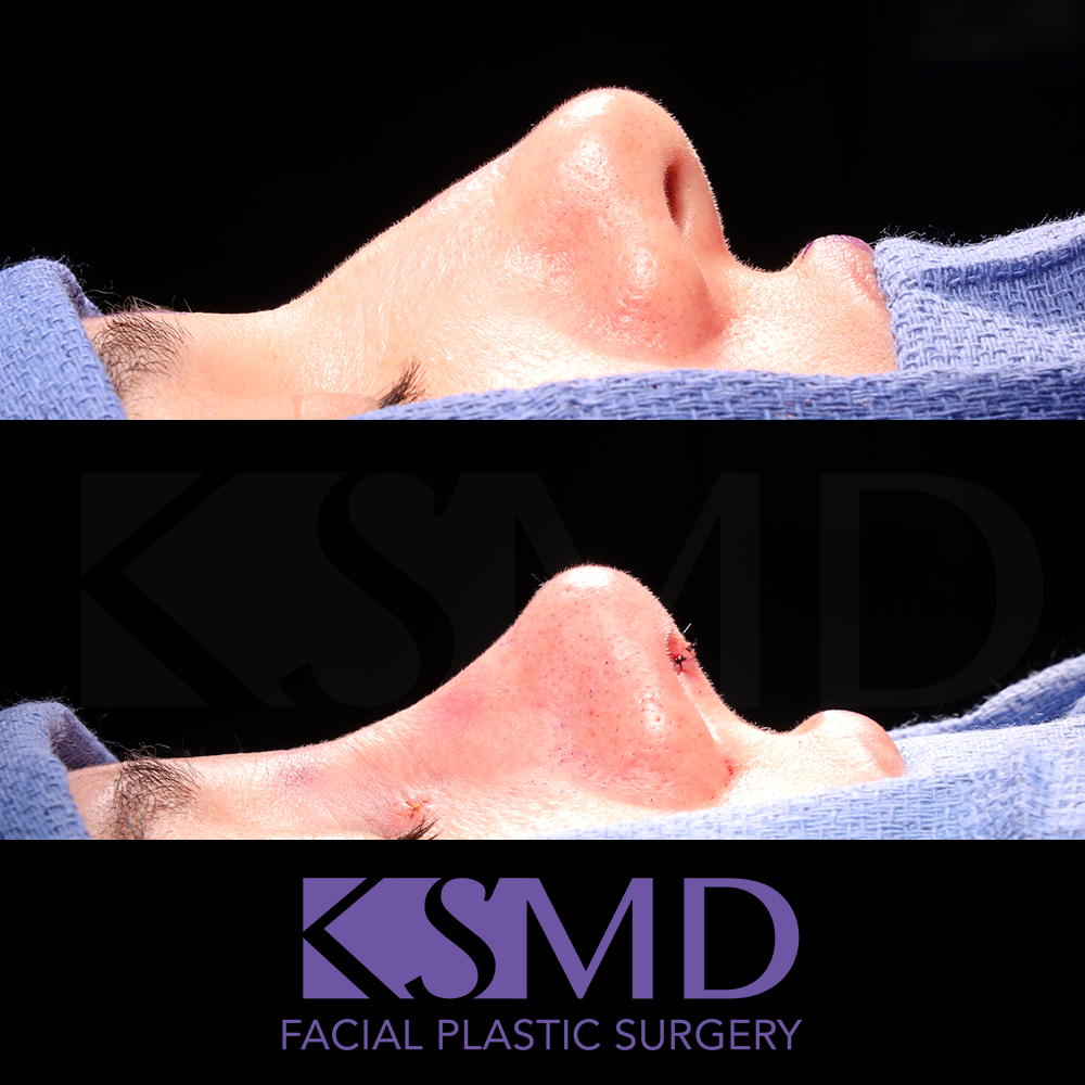MG profile 1 intraop