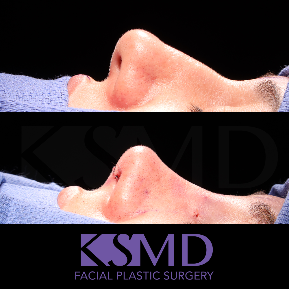 MG profile 2 intraop