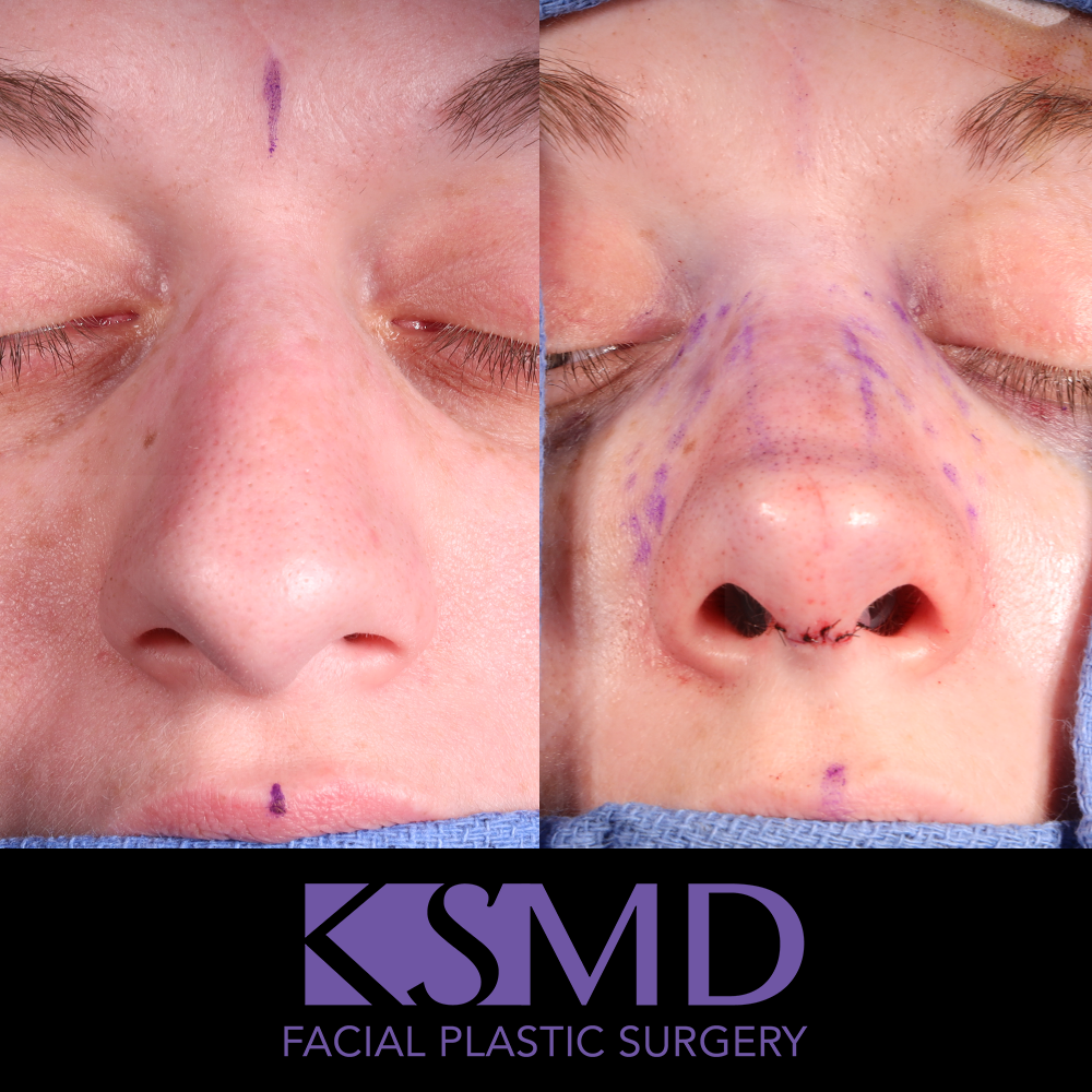 ND frontal 2 intraop