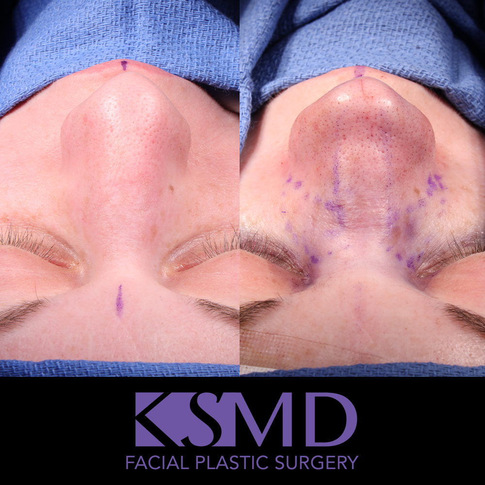 ND frontal intraop