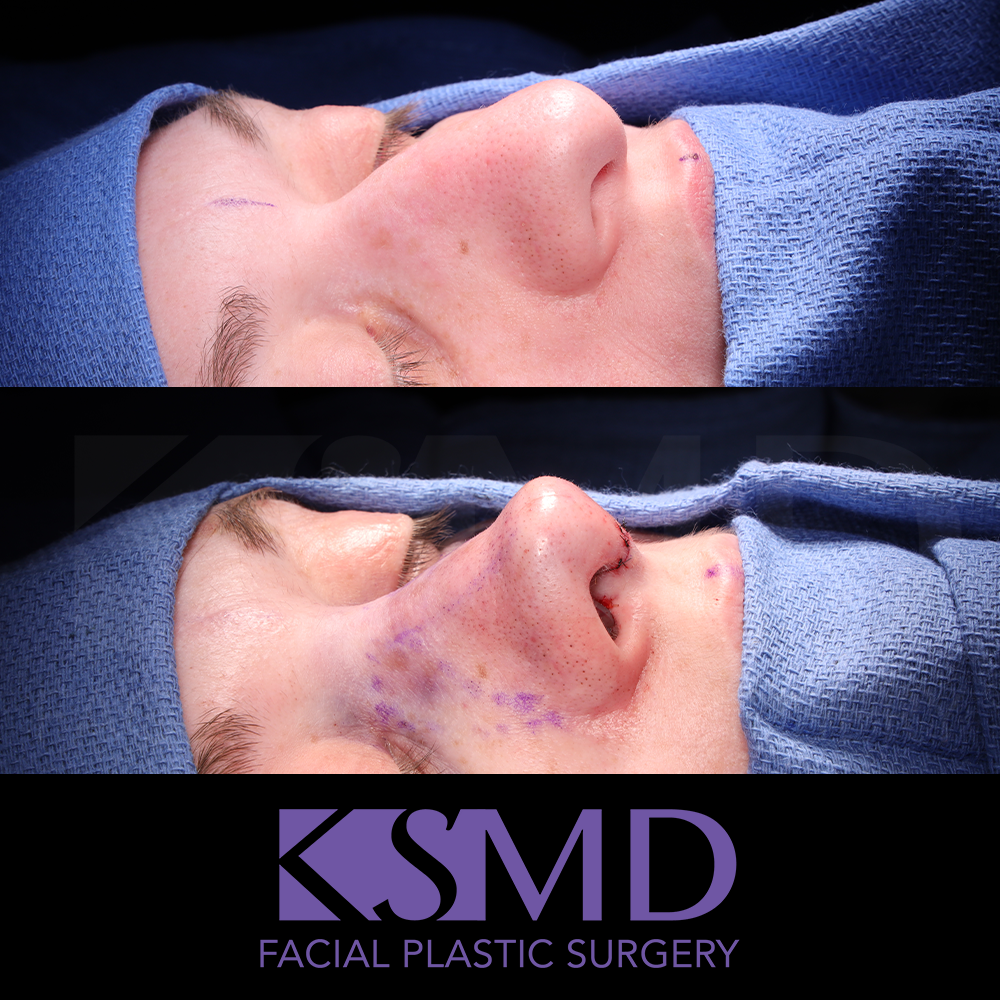 ND oblique 1 intraop