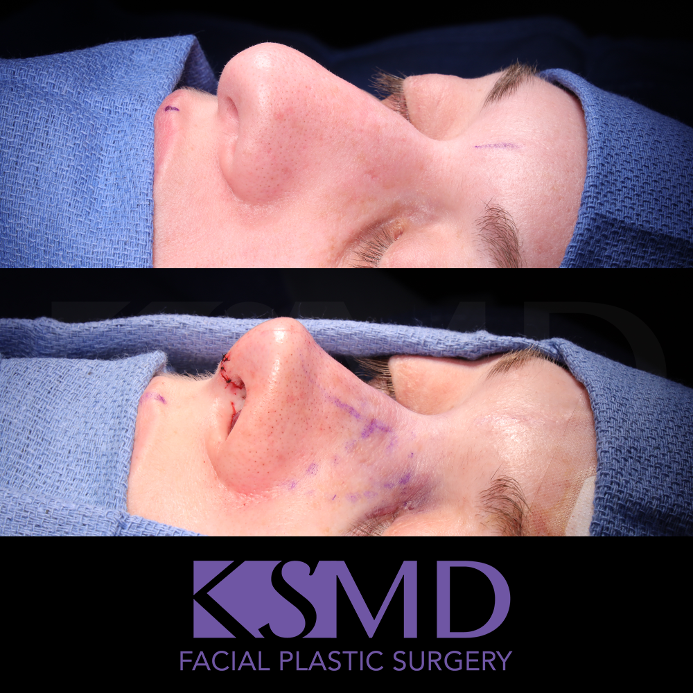ND oblique 2 intraop