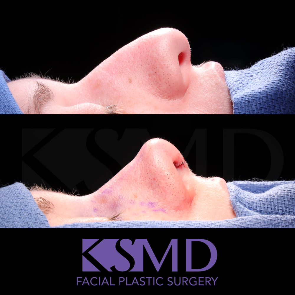 ND profile 1 intraop