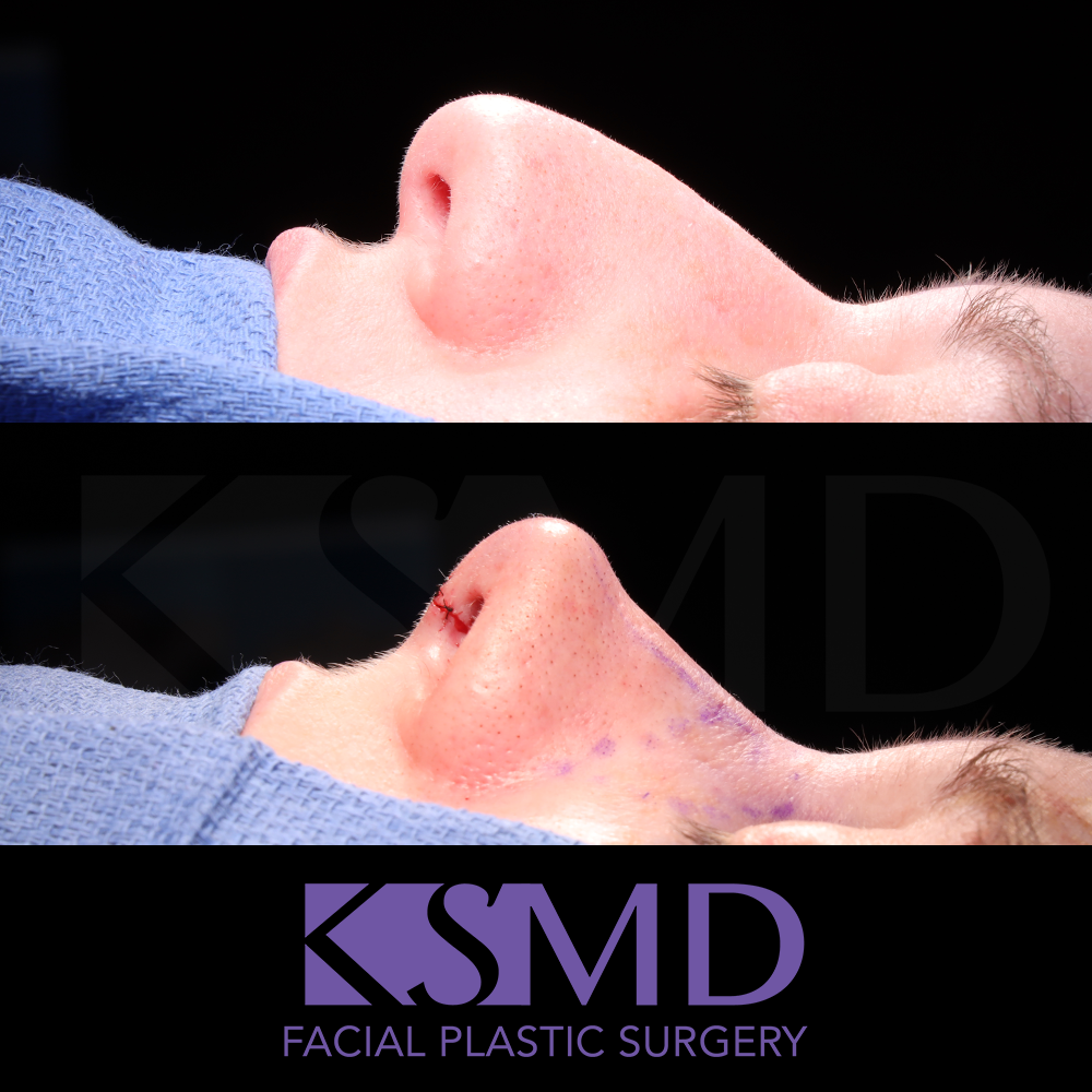 ND profile 2 intraop