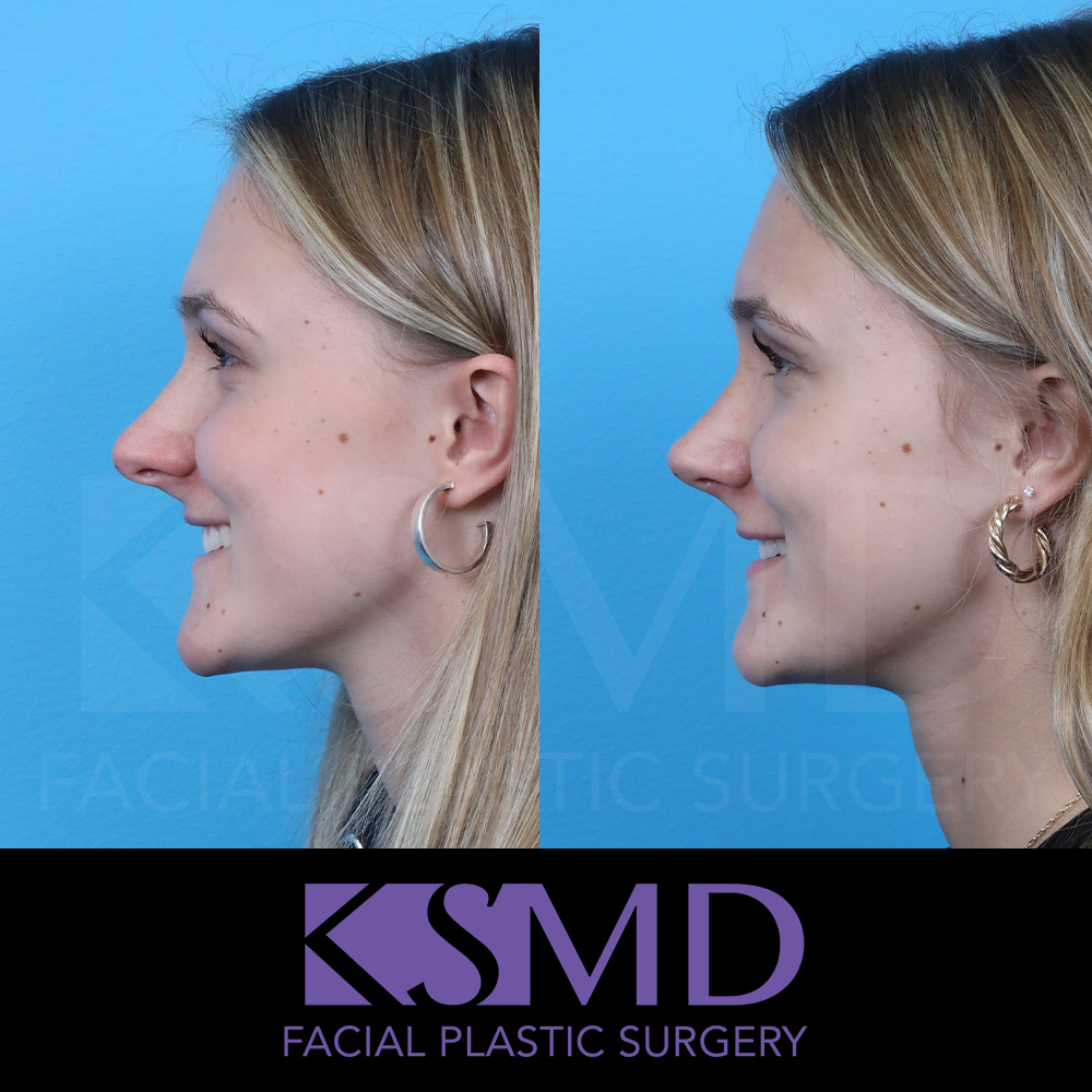 OZ 6 wk profile1 smile