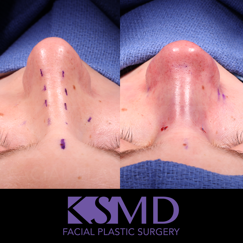 OZ frontal 1