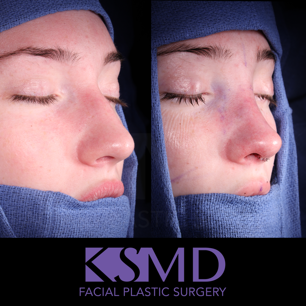 SL oblique 1 intraop