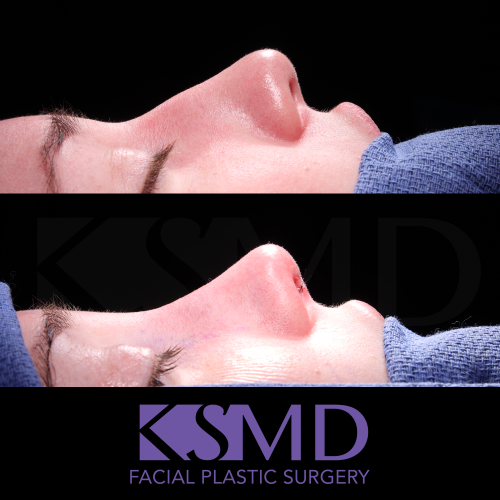 SL profile 1 intraop