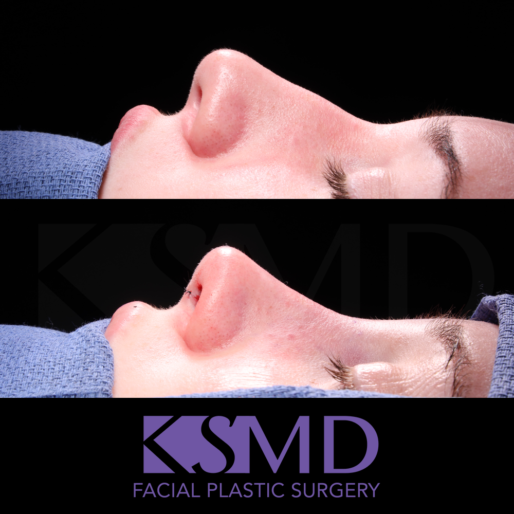 SL profile 2 intraop