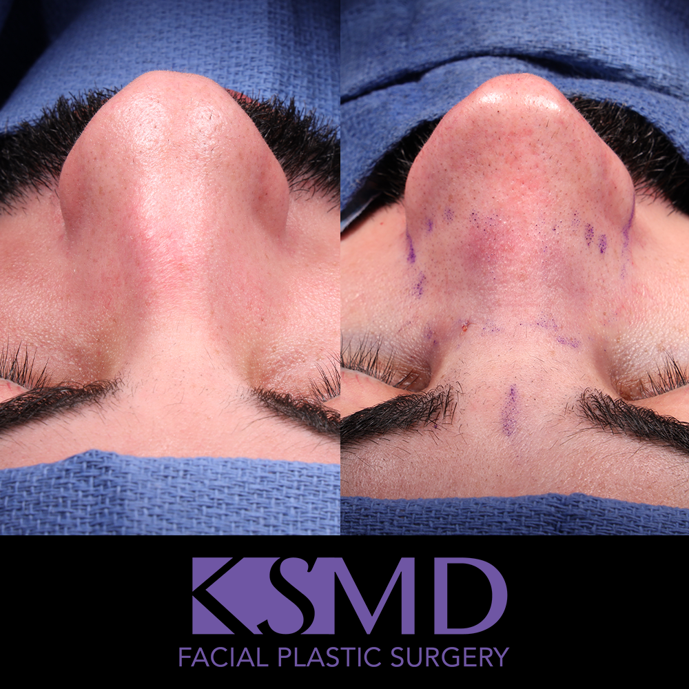 SO intraop frontal