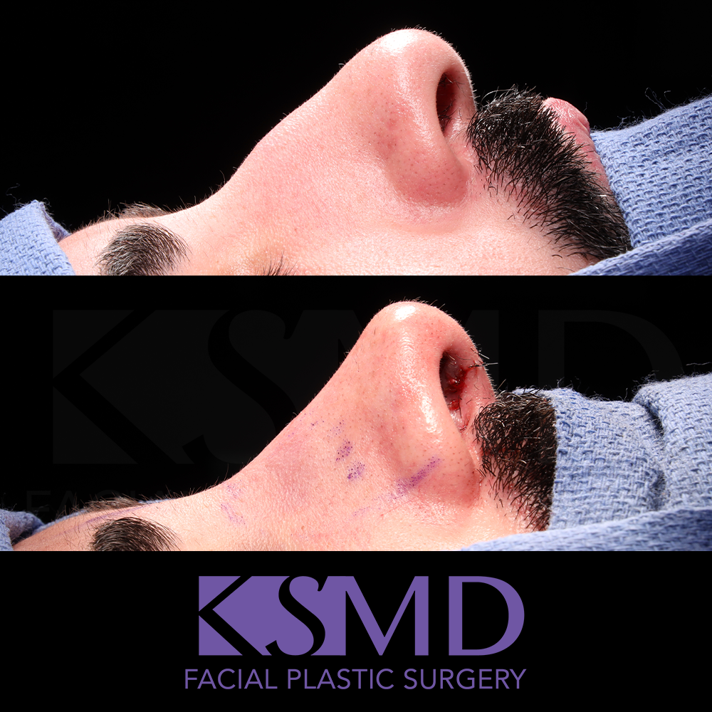 SO intraop profile 1