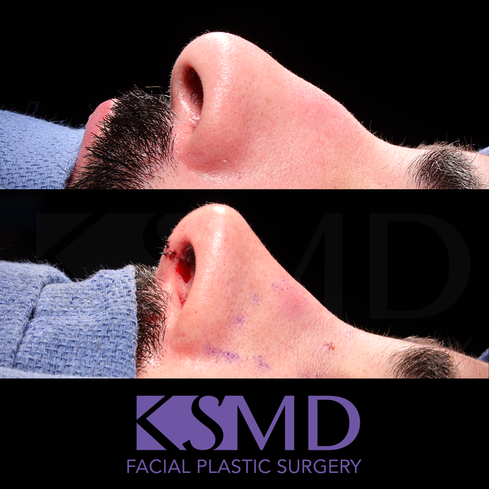 SO intraop profile 2