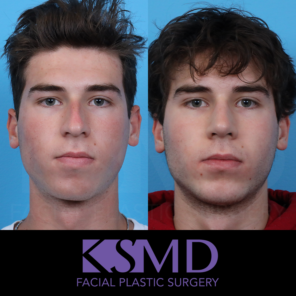 SS frontal 2 month