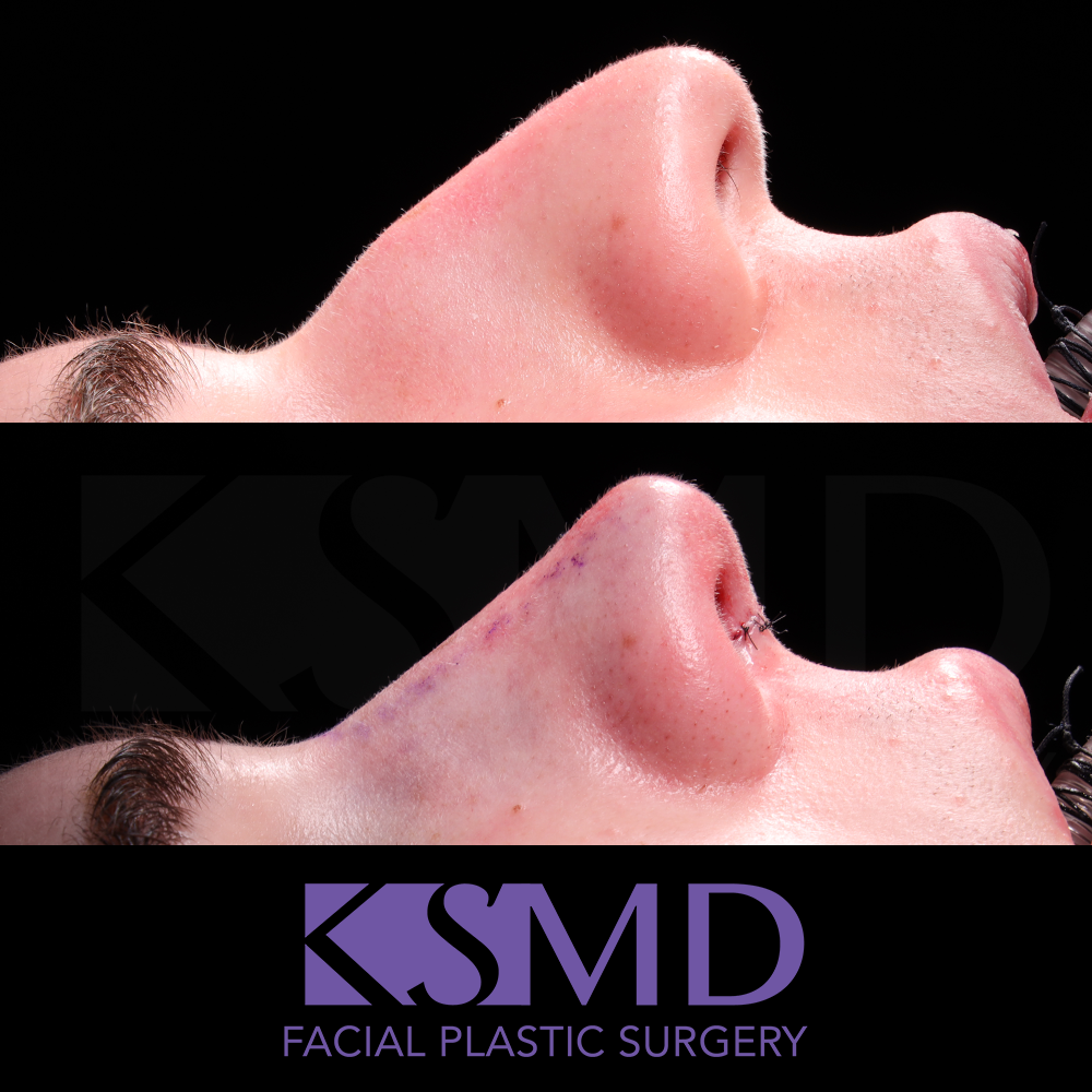 SS profile 1 intraop